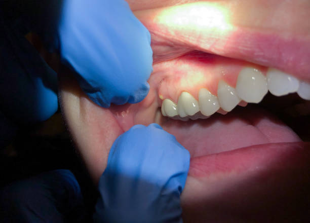 Best Emergency Wisdom Teeth Removal in Muscoy, CA